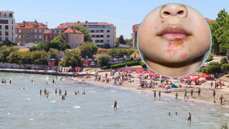 Zaraza “slatke kraste” na hrvatskim plažama: Doktori kažu da se lako širi