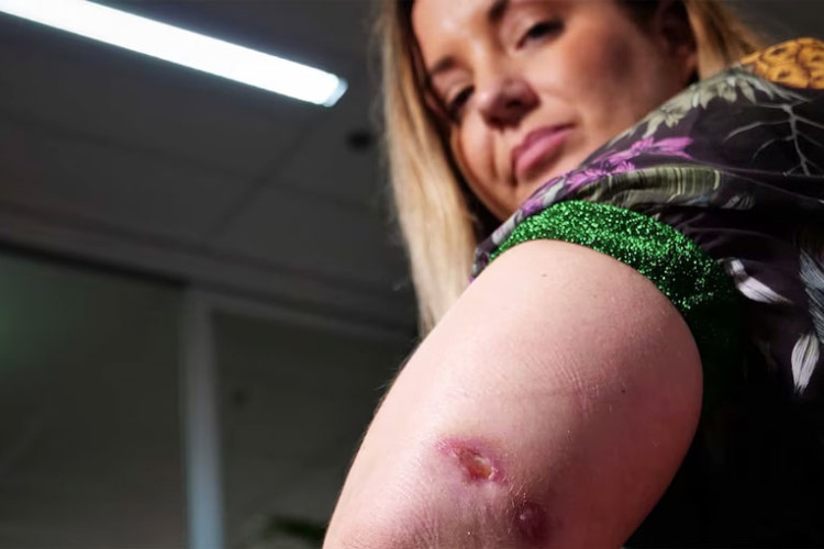 Raste broja slučajeva bakterije koja jede meso